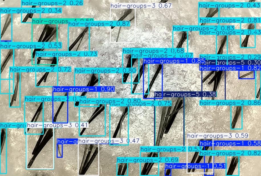 Automating Hair Counting with YOLOv5 and Custom Models: An Entro Solutions Innovation